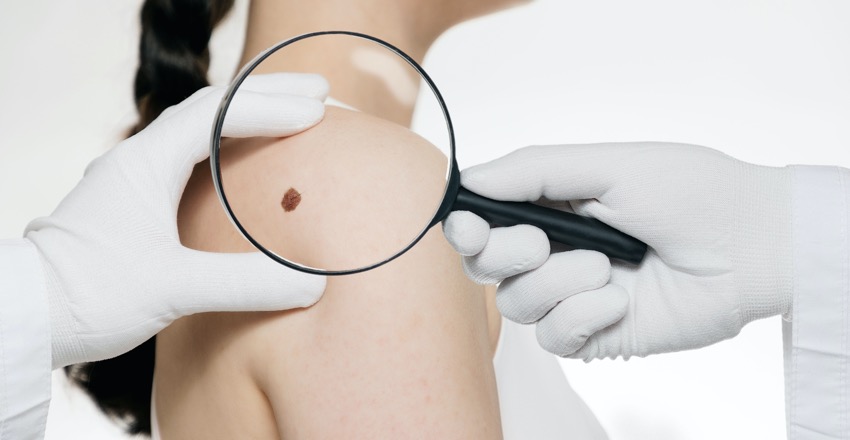 A skin cancer GP spotting melanoma during a skin cancer check in GPs in Curzon